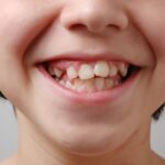 How To fix Crooked Teeth Without Braces